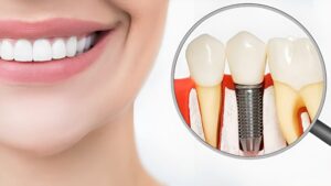 The Ultimate Smile Fix Starts with Dental Implants Dubai