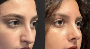 Rhinoplasty in Dubai