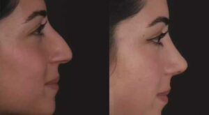 Septoplasty in Dubai