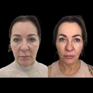 Is Profhilo Treatment in Dubai the Best Non-Surgical Solution for Skin Tightening