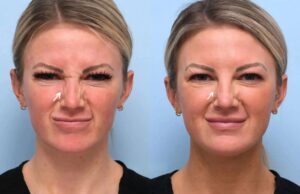 Enhancing Your Smile with Botox: Tips from the Best Doctors in Dubai