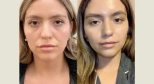 Thread Lift in Dubai: How Long Do the Results Really Last