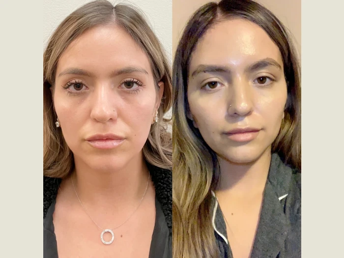 Thread Lift in Dubai: How Long Do the Results Really Last