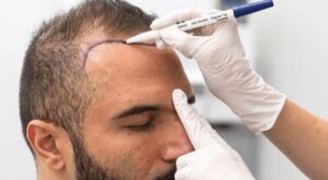 Hair Transplant