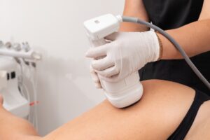 How Liposonix Is Revolutionizing Body Contouring