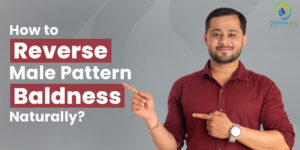How to Reverse Male Pattern Baldness Naturally