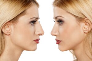 Is the Recovery Process Painful After Rhinoplasty in Dubai?