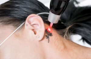 Laser Tattoo Removal: A Tattoo-Free Future