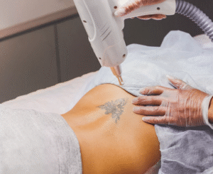 Laser Tattoo Removal: Options for Dark Skin