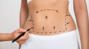 Liposuction Surgery in Dubai