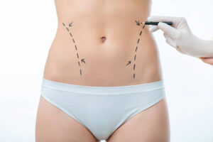 The Ideal Candidate for Liposuction in Riyadh: Who Qualifies?
