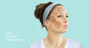 Melasma Treatment: Trusted Advice From Experts
