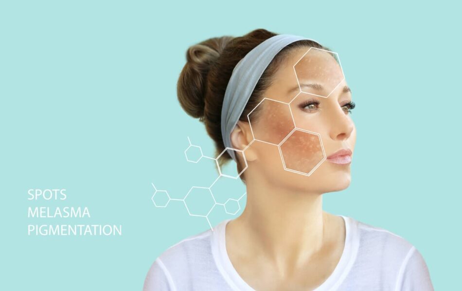 Melasma Treatment: Trusted Advice From Experts