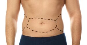 Tummy Tuck Benefits That Go Beyond Just Flat Abs