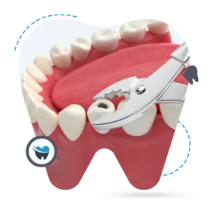 wisdom teeth extraction perth
