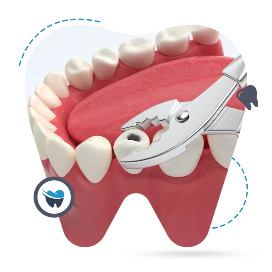 wisdom teeth extraction perth