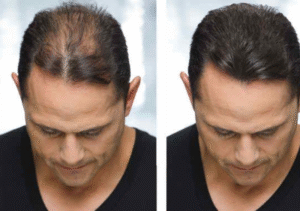 Discover the Truth About Hair Transplant Cost in Dubai: What You Should Know