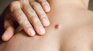 Skin Wart Removal Cost in Dubai