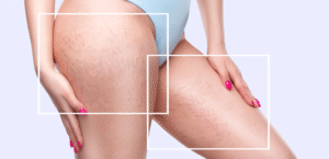 Stretch Marks Removal: Lifestyle Tips That Support