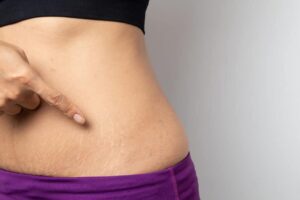 Stretch Marks Removal: Tips for Lasting Results