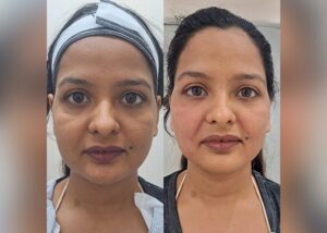 Face Lifting Treatment: Defy Gravity with Confidence