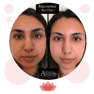 How CO2 Laser Treatment Transforms Your Facial Skin: The Science Behind the Results