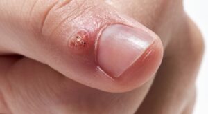 Skin Wart Removal Cost in Dubai