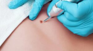 Skin Wart Removal Cost in Dubai