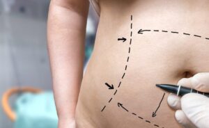 Will Insurance Cover Any Part of a Mini Tummy Tuck in Dubai?
