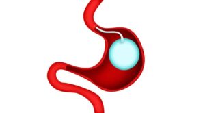 Gastric Balloon Placement in Dubai