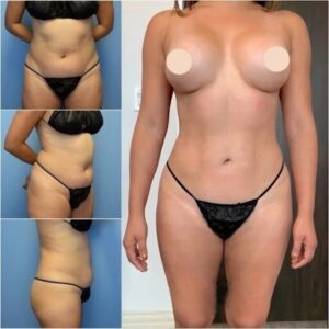 Best Body Contouring Surgeons in Dubai: How to Avoid Common Mistakes