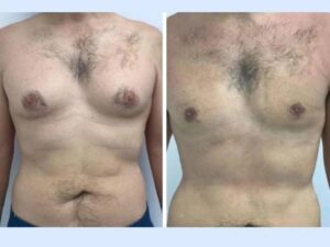 Gynecomastia in Dubai: Step-by-Step Surgical Recovery Timeline
