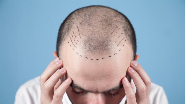 How To Choose The Right Hair Transplant Clinic Today?