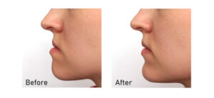 What Teens and Adults Should Know About Chin Reduction in Islamabad