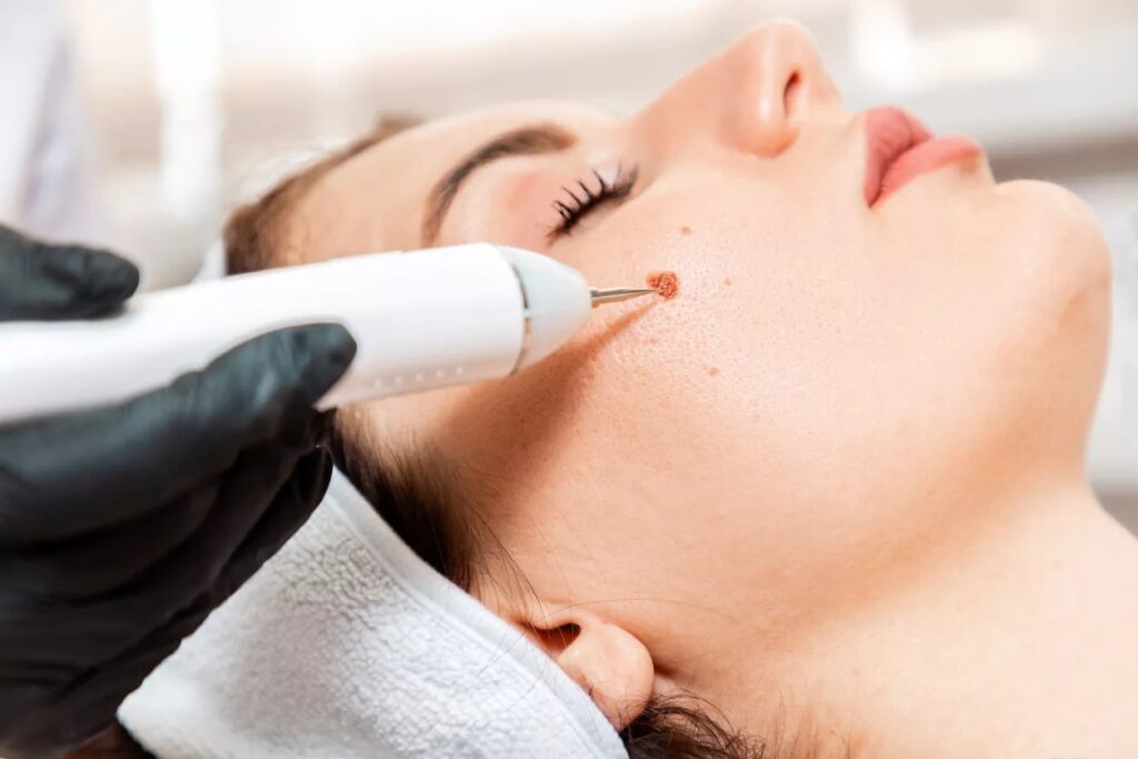 Skin Wart Removal Cost in Dubai