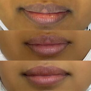 Before and After Results of Lip Pigmentation Treatment: What to Expect
