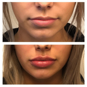 Lip Fillers Dubai for All Ages: Who’s Getting Them and Why