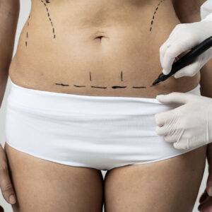 Best Liposuction Options for a Smooth and Sculpted Look