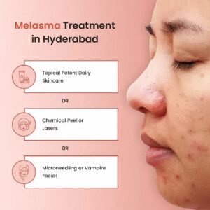 Melasma Treatment: Restore Radiance and Even-Toned Skin