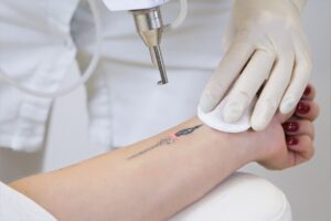 Laser Tattoo Removal: Erase the Past with Confidence