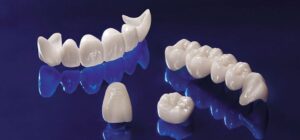 Dental Crowns and Bridges in Dubai