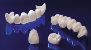 Dental Crowns and Bridges in Dubai