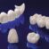 Dental Crowns and Bridges in Dubai