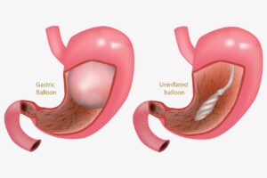 Gastric Balloon Placement in Dubai
