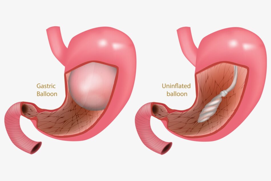 Gastric Balloon Placement in Dubai
