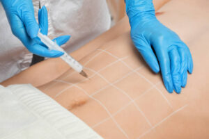 إزالة التثدي نهائياً في الرياض