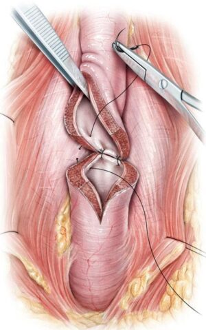 Understanding Urinary Strictures: Causes, Symptoms, and Treatment
