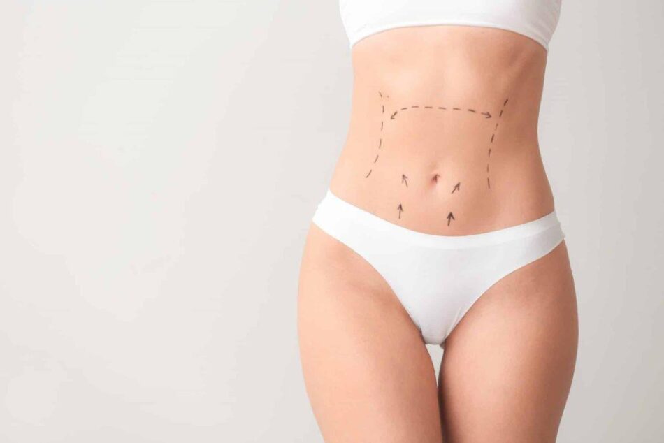 Tummy Tuck Surgery Dubai: Best Practices for Long-Lasting Results