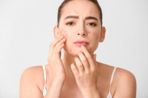 Safe Acne Treatment Approaches to Prevent Scars and Dark Spots