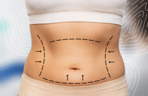 Achieve Maximum Definition with Vaser 4D Liposuction